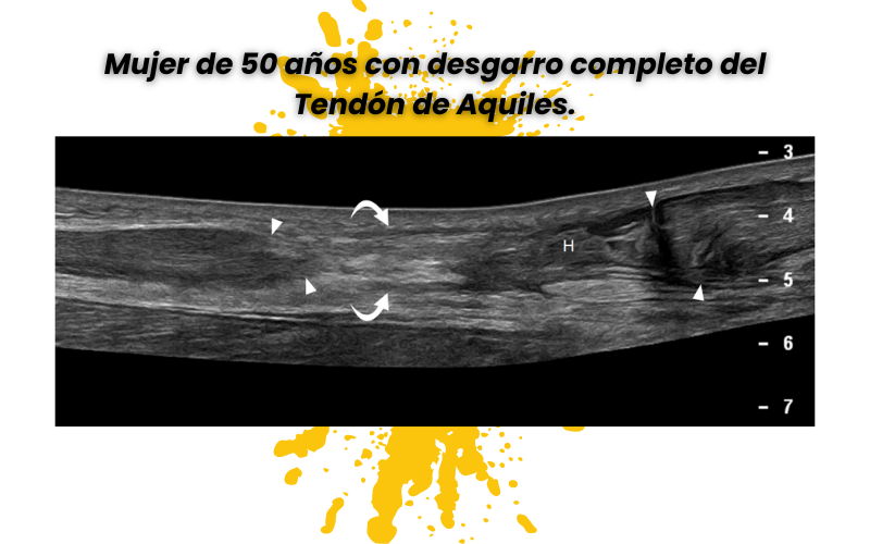 4. Tendon aquiles ecografia tempo formacion.png